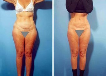 Liposuction
