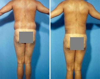 Liposuction