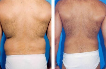 Liposuction