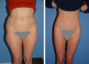 Liposuction