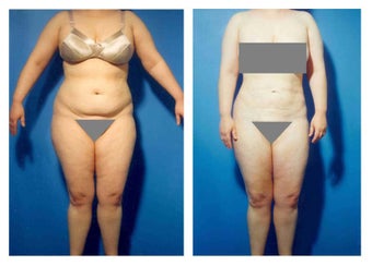 Liposuction