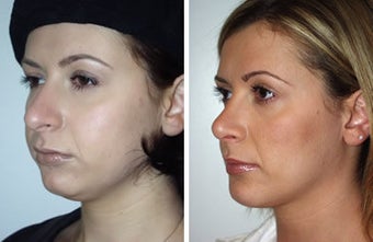 Rhinoplasty and liposuction under chin