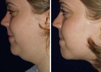 Liposuction of Chin