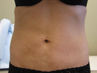 Lipotherme