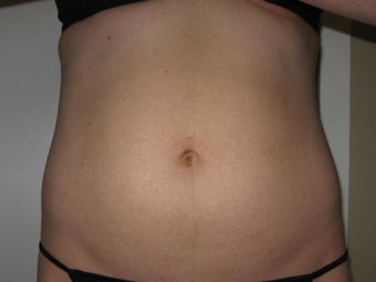 Lipotherme