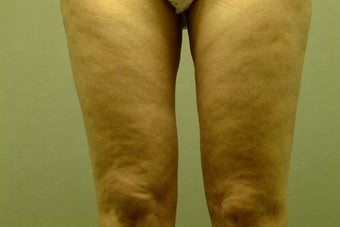 Smart Lipo-Liposuction