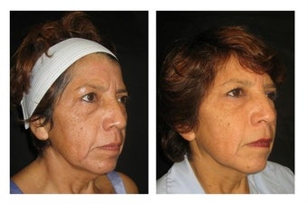 Non-Surgicial Facelift