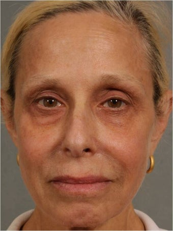 60 Year Old Female treated for under eye puffiness, sagging cheeks and frown lines non surgically
