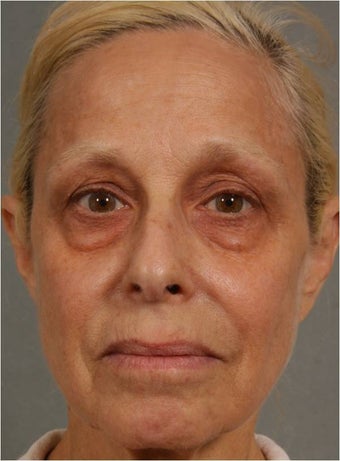 60 Year Old Female treated for under eye puffiness, sagging cheeks and frown lines non surgically
