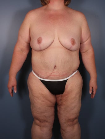 Lower body lift, breast reduction, brachioplasty, medial thigh lift