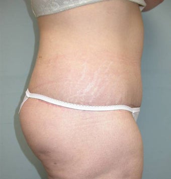 Before and After Lower Body Lift