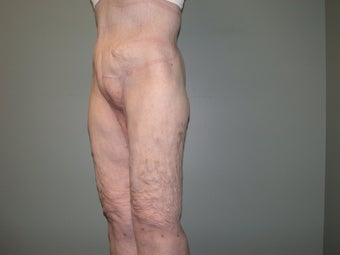 Lower body lift