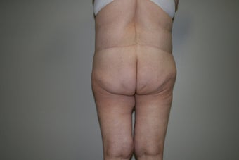 Lower body lift