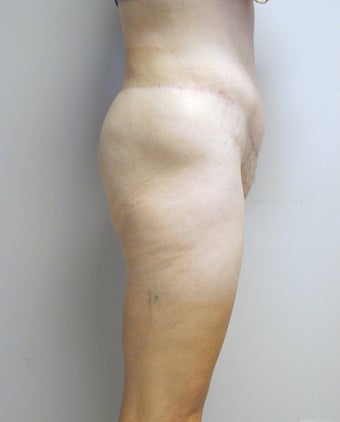Before and After Lower Body Lift (Lateral View)