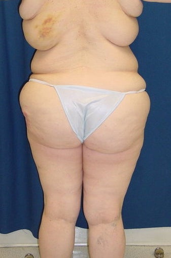 Post bariatric surgery lower body lift