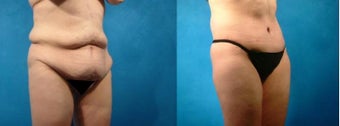 Lower Body Lift