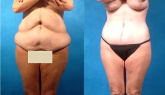 Lower Body Lift with Liposuction and Fat Transfer