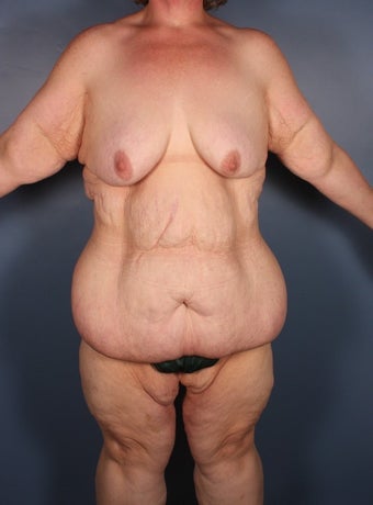 Lower body lift, breast reduction, brachioplasty, medial thigh lift