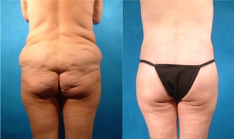 Lower Body Lift with Fat Transfer and Liposuction