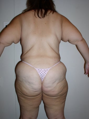 Contouring after massive weight loss