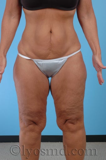Lower Body Lift, Inner Thigh Lift