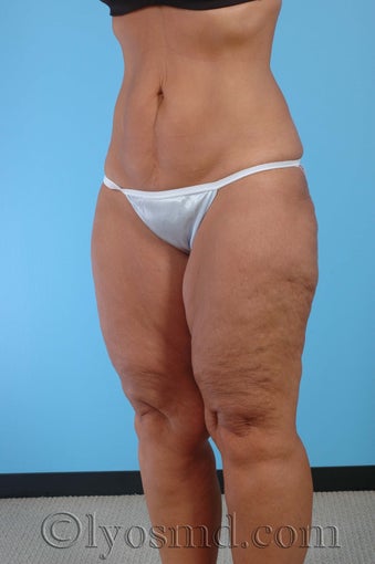 Lower Body Lift, Inner Thigh Lift