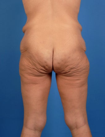 Buttock lift