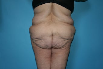 Lower body lift