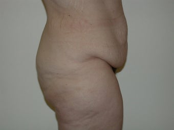 Lower Body Lift