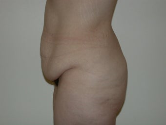 Lower Body Lift