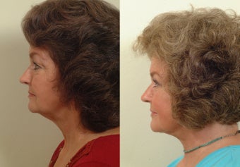 Lower facelift and eyelids