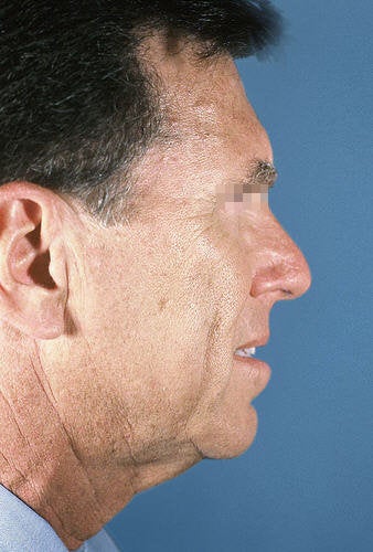 Facelift for Men