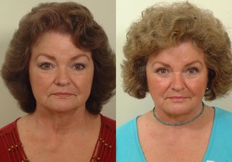 Lower facelift and eyelids