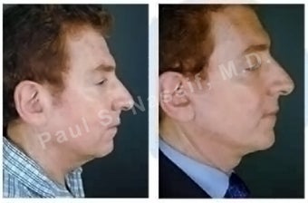 Lower Face and Neck Lift