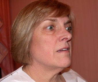 Facelift, Neck lift, Blepharoplasty