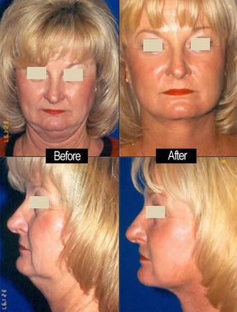 Facelift