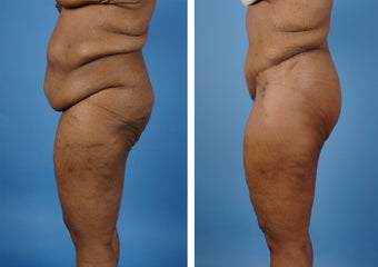 Lower Body Lift with Laser Liposuction to the Hips and Thighs