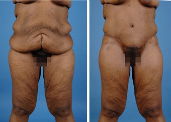 Lower Body Lift with Laser Liposuction to the Hips and Thighs