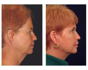 Lower Face & Neck Lift