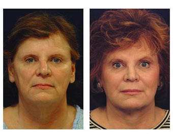 Lower Face and Neck Lift
