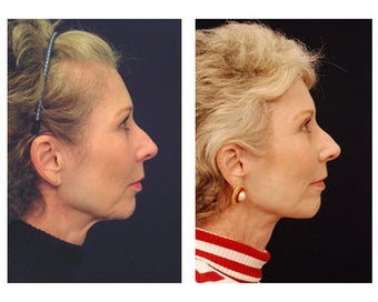 Lower Face and Neck Lift