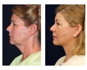 Lower Face and Neck Lift