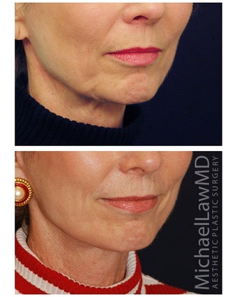 Lower Face and Neck Lift