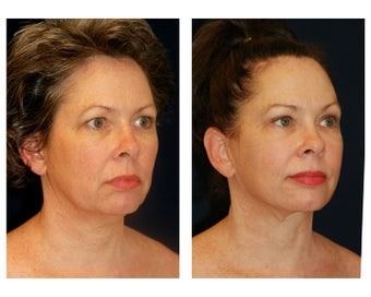 Facial Rejuvenation