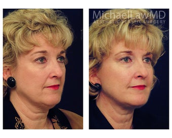 Lower Face and Neck Lift