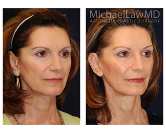 Facial Rejuvenation