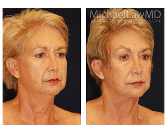 Facial Rejuvenation