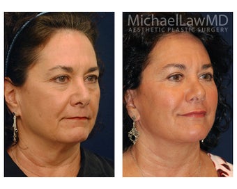 Facial Rejuvenation - Lower Face Lift