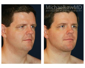 Lower Face and Neck Lift