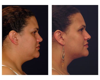 Lower Face and Neck Lift
